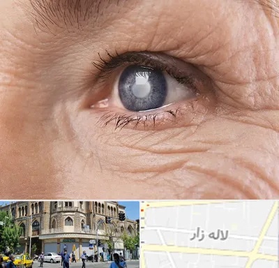 متخصص آب مروارید در لاله زار