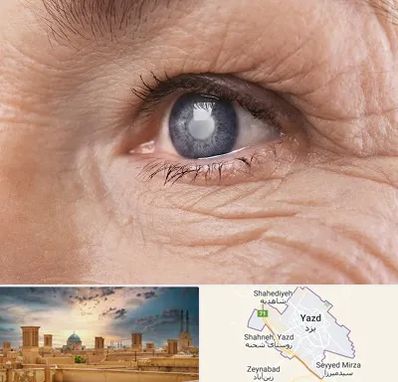 متخصص آب مروارید در یزد