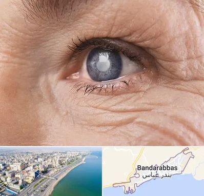 متخصص آب مروارید در بندرعباس