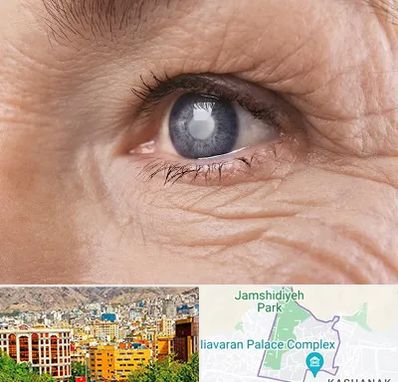 متخصص آب مروارید در نیاوران