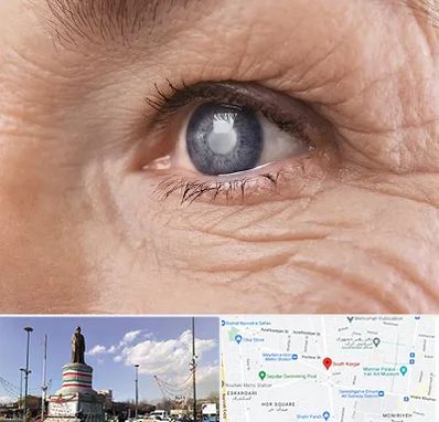 متخصص آب مروارید در کارگر جنوبی