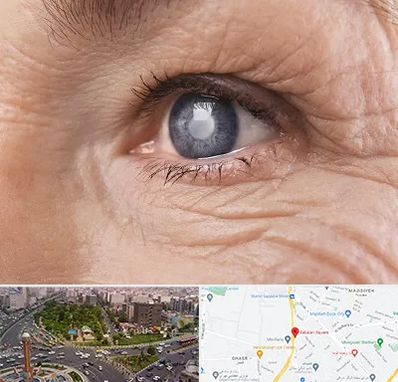 متخصص آب مروارید در سبلان