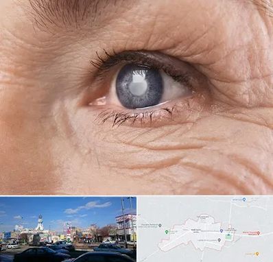 متخصص آب مروارید در ماهدشت کرج