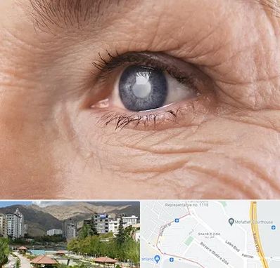 متخصص آب مروارید در شهر زیبا