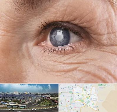 متخصص آب مروارید در منطقه 15 تهران