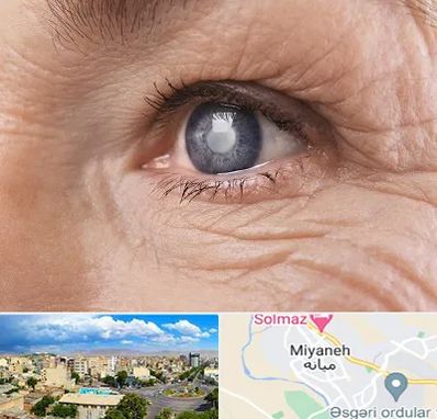 متخصص آب مروارید در میانه