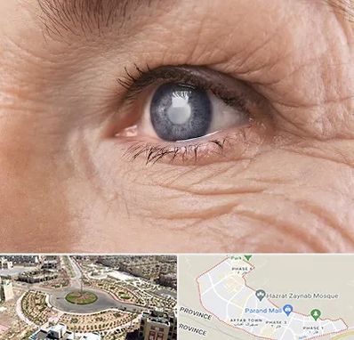 متخصص آب مروارید در پرند