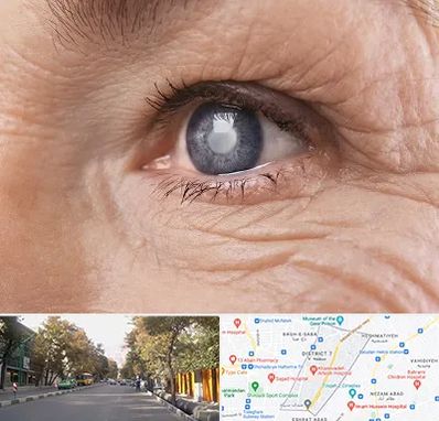 متخصص آب مروارید در شریعتی