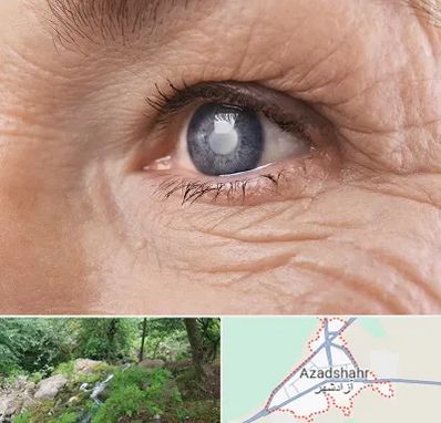 متخصص آب مروارید در آزادشهر