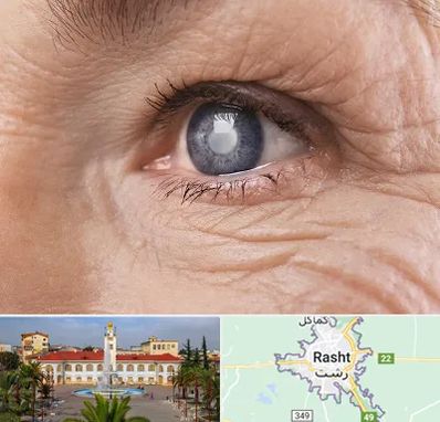 متخصص آب مروارید در رشت