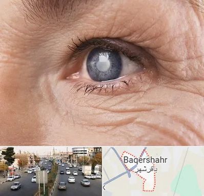 متخصص آب مروارید در باقرشهر