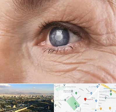 متخصص آب مروارید در هنگام