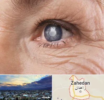 متخصص آب مروارید در زاهدان