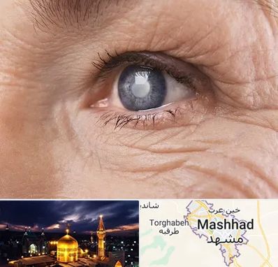 متخصص آب مروارید در مشهد