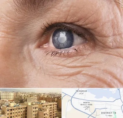 متخصص آب مروارید در جنوب غرب تهران