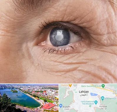 متخصص آب مروارید در لاهیجان