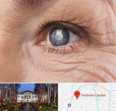 متخصص آب مروارید در باغ فردوس