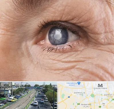 متخصص آب مروارید در جنوب تهران