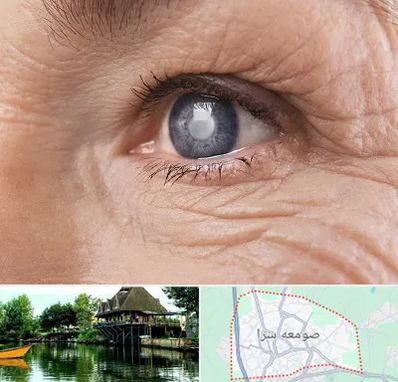 متخصص آب مروارید در صومعه سرا