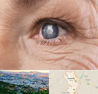 متخصص آب مروارید در سنندج