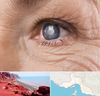 متخصص آب مروارید در هرمزگان