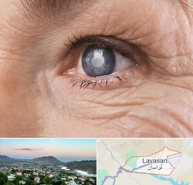 متخصص آب مروارید در لواسان