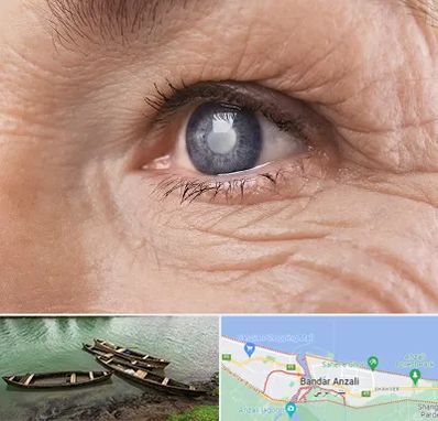 متخصص آب مروارید در بندر انزلی