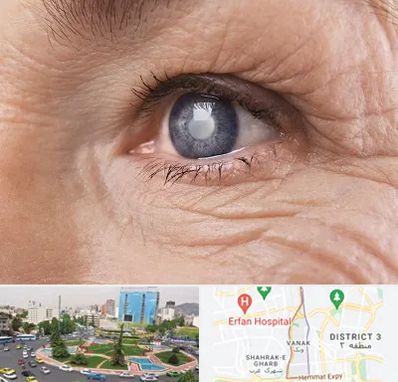 متخصص آب مروارید در ونک