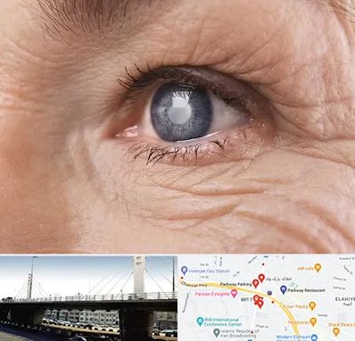 متخصص آب مروارید در پارک وی