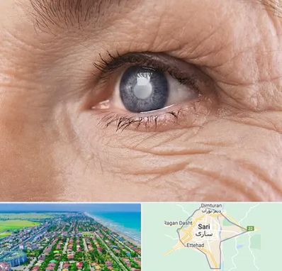 متخصص آب مروارید در ساری