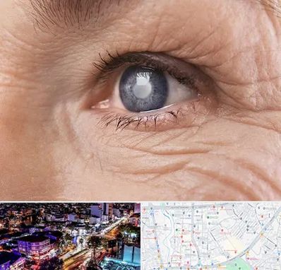 متخصص آب مروارید در منظریه رشت