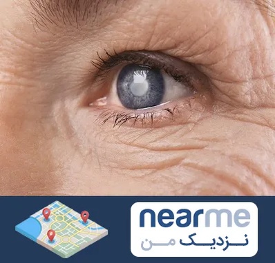 متخصص آب مروارید در نزدیک من