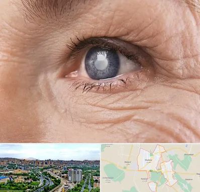 متخصص آب مروارید در شهریار