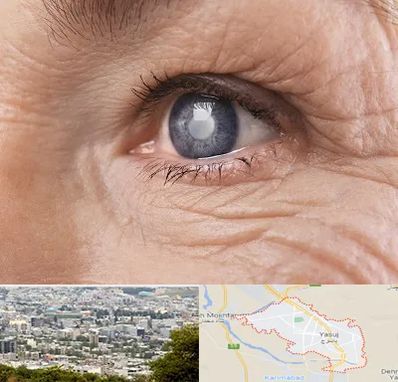 متخصص آب مروارید در یاسوج