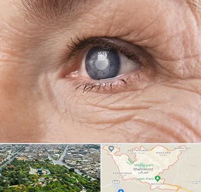 متخصص آب مروارید در شهرکرد