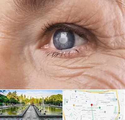 متخصص آب مروارید در سرسبز