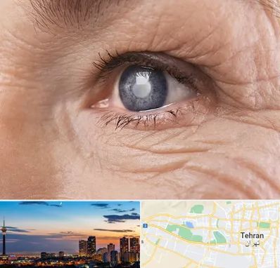 متخصص آب مروارید در غرب تهران