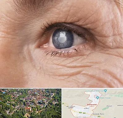 متخصص آب مروارید در دماوند