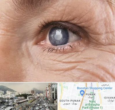 متخصص آب مروارید در پونک