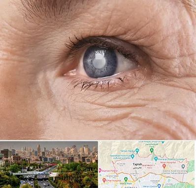 متخصص آب مروارید در منطقه 1 تهران