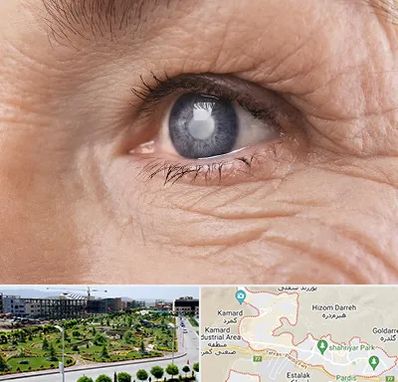 متخصص آب مروارید در پردیس