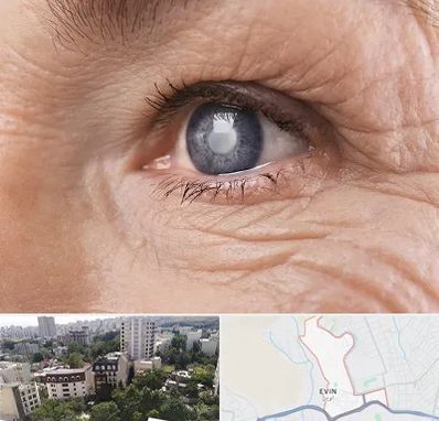 متخصص آب مروارید در اوین