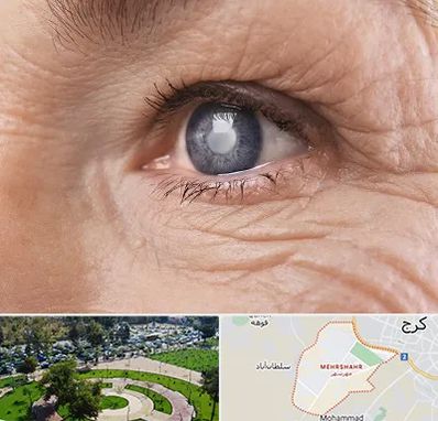 متخصص آب مروارید در مهرشهر کرج