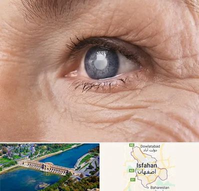 متخصص آب مروارید در اصفهان