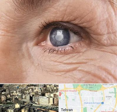 متخصص آب مروارید در مرزداران