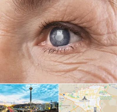 متخصص آب مروارید در تهران