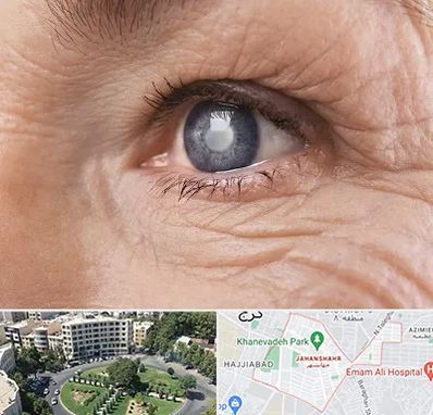 متخصص آب مروارید در جهانشهر کرج