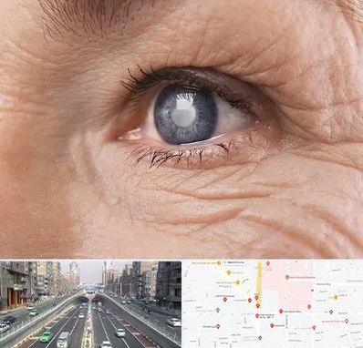 متخصص آب مروارید در توحید