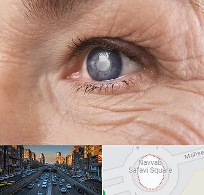 متخصص آب مروارید در نواب