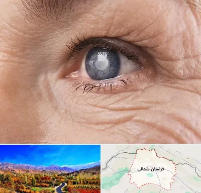 متخصص آب مروارید در خراسان شمالی
